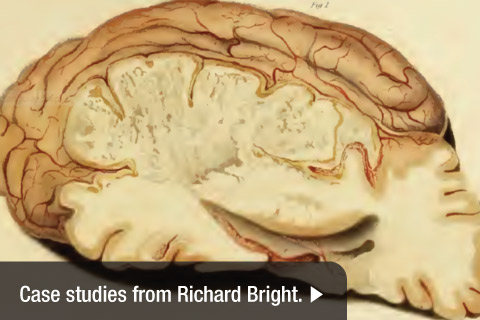 Richard Bright Advanced Research on Apoplexy, Stroke
