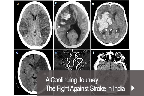 A Continuing Journey: The Fight Against Stroke in India