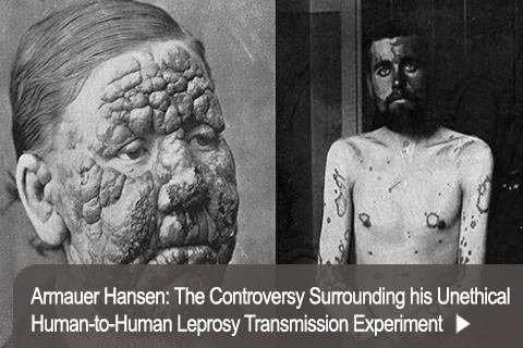 Armauer Hansen: The Controversy Surrounding his Unethical Human-to-Human Leprosy Transmission Experiment